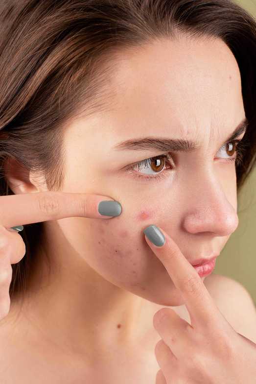 Naturopathic Approach to Treat Acne