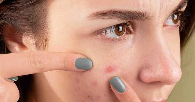 The Naturopathic Approach to Treat Acne: Clearing Skin Naturally image