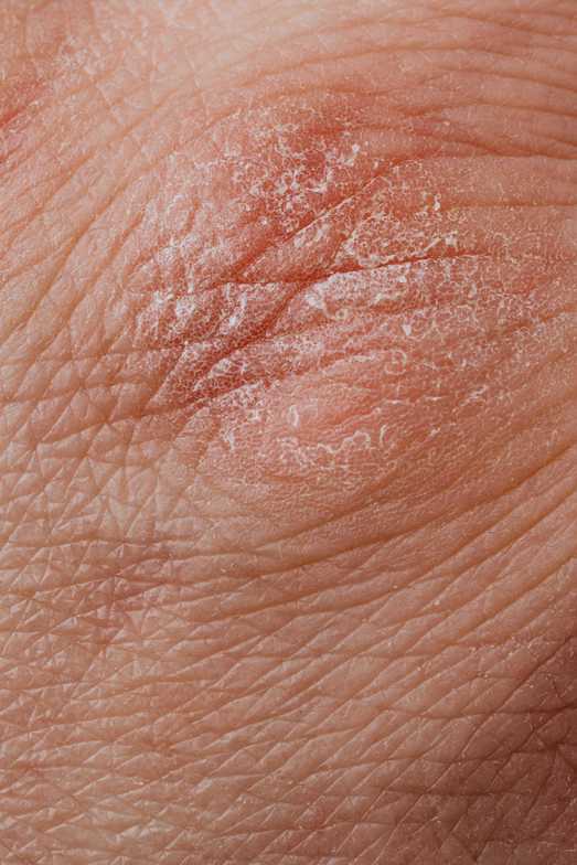 psoriasis symptoms and treatment